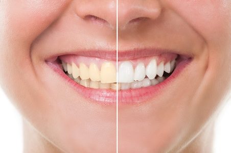 Best Results Teeth Whitening Dublin CA - Dr. Munira Lokhandwala 