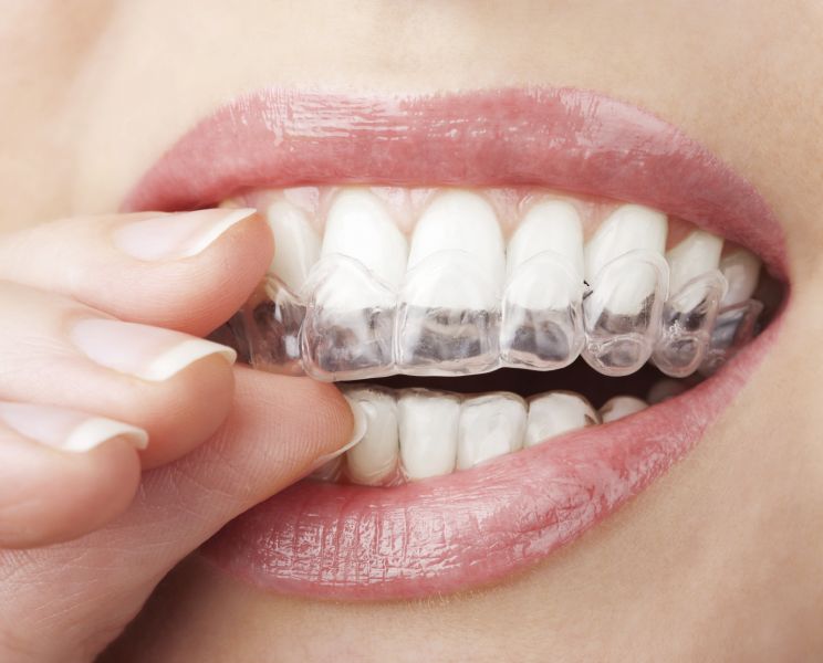 Best invisalign in Nashua