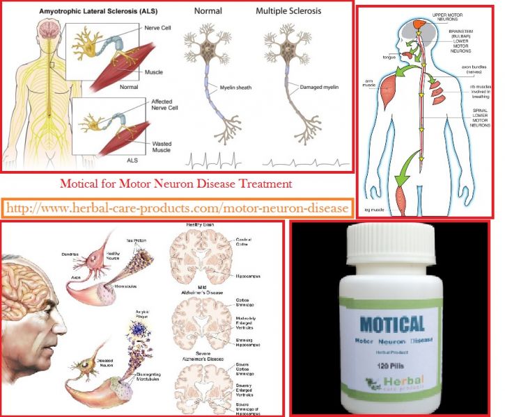 Motor Neuron Disease Natural Treatment