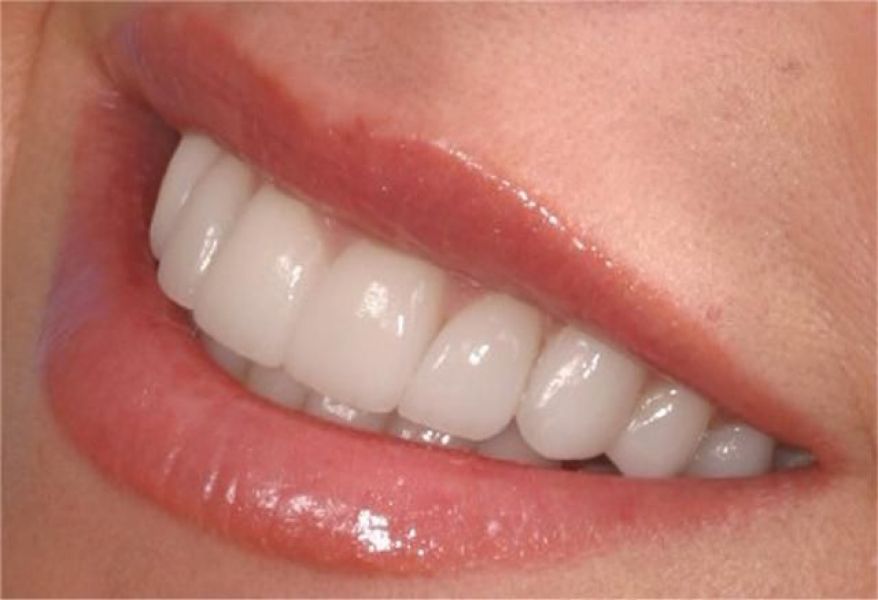 Affordable Dental Crowns and Bridges Wayne