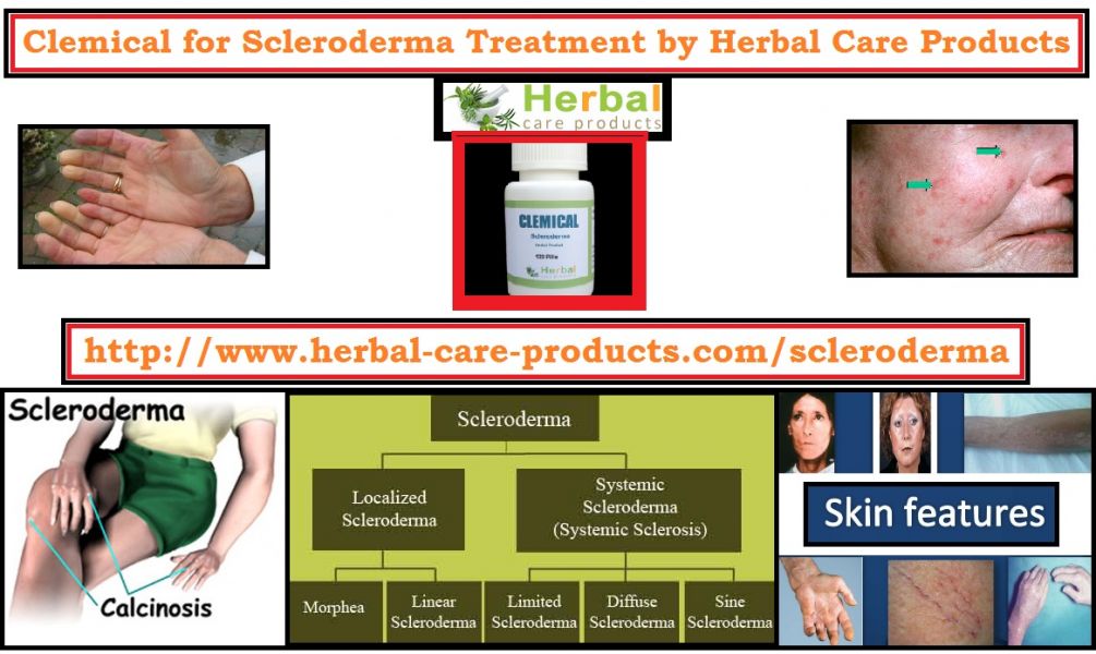 Natural Herbs for Scleroderma Herbal Treatment
