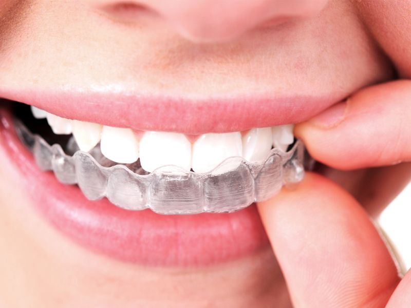 Invisalign in Alpharetta