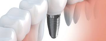 Dental implants in Miami