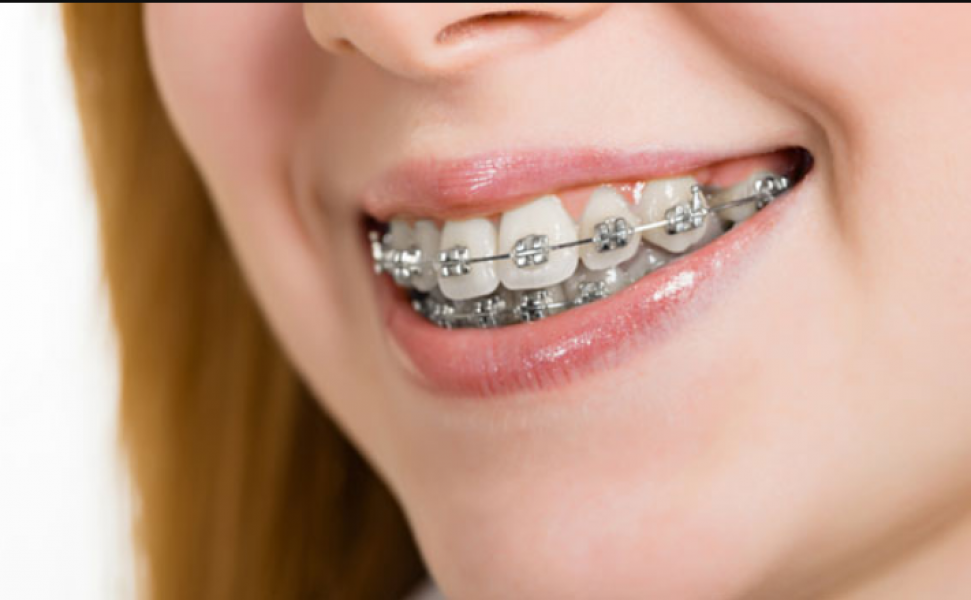 High-Quality Braces Treatment for Adults in Chesterfield, MO