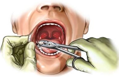Affordable Dental Extractions in Middletown OH