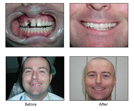 Certified Full Upper Teeth Replacement Chicago, IL 