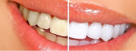 Recommended Zoom Teeth Whitening in Hanford CA