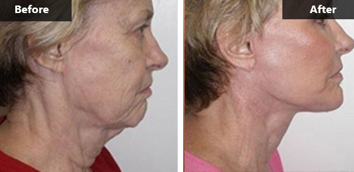 Visit Dr. Ariel Ostad - Best Results Facelift  New York City