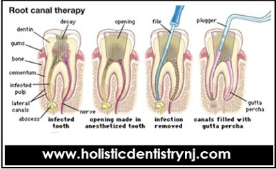 Root Canal Treatment in New Jersey at Affordable Cost