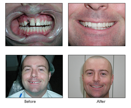 Recommended Dental Implants Chicago, IL 