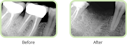 Dental Bone Graft Fort Lauderdale Near To Me - Dr. Yolanda Cintron