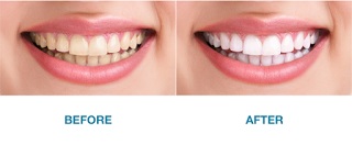 Nearest Home Teeth Whitening Services Charleston, SC 