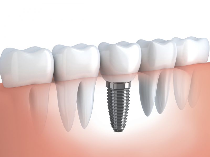 Tooth Replacement in Wayne