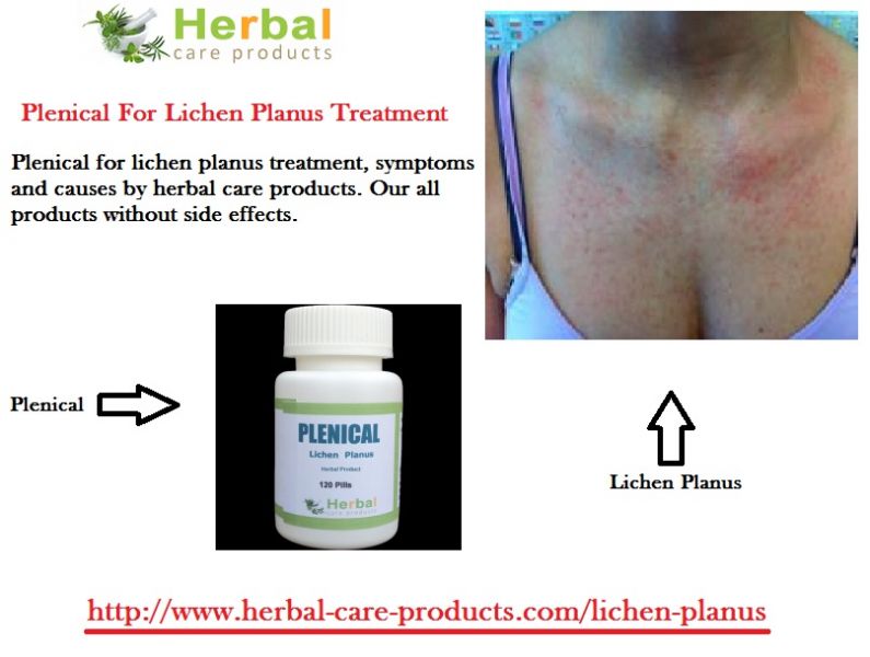 Lichen Planus Herbal Treatment