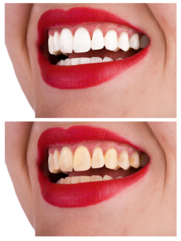 Teeth Whitening near Miami