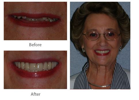 Certified Dentures Lakewood - Dr. Scott Stewart