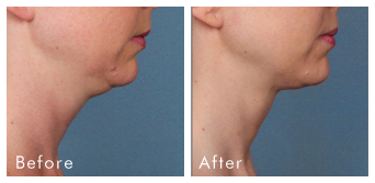Recommended Kybella Montclair NJ - 07042- Dr. Jeanie Downie 