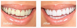 Visit Dr. George Moutevelis - Best Results Teeth Whitening Woburn 