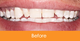 Certified Root Canal Kennesaw - Dr.Lan Vo & Breckley 