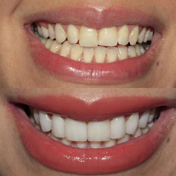 Best Dental Implants