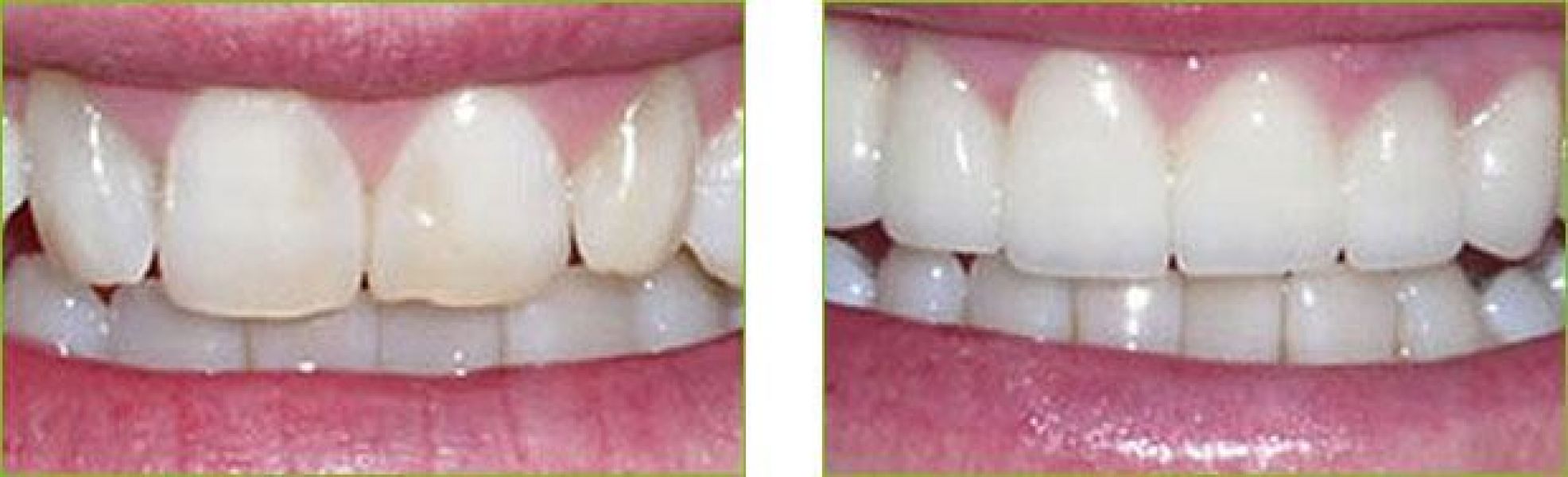 Recommended Ceramic Reconstruction in Sterling Heights