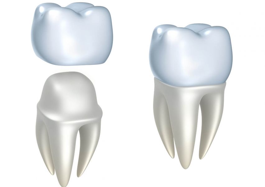 Teeth Implants Dentist New York NY